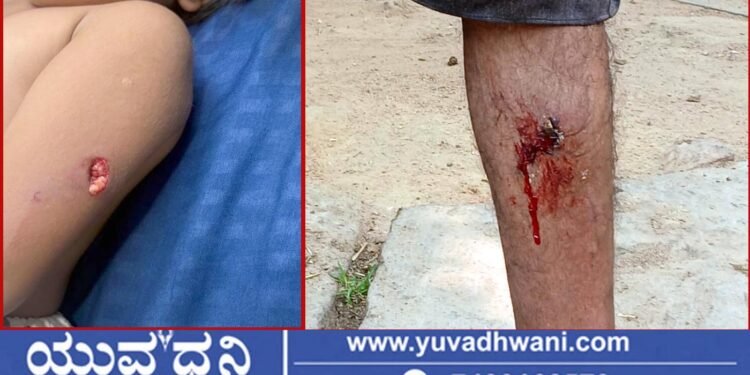 ಸೋಮಿನಕೊಪ್ಪದಲ್ಲಿ ಬಾಲಕಿ ಸೇರಿದಂತೆ ಇಬ್ಬರ ಮೇಲೆ ಬೀದಿ ನಾಯಿ ದಾಳಿ!